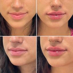 Labial voluminizador💉
